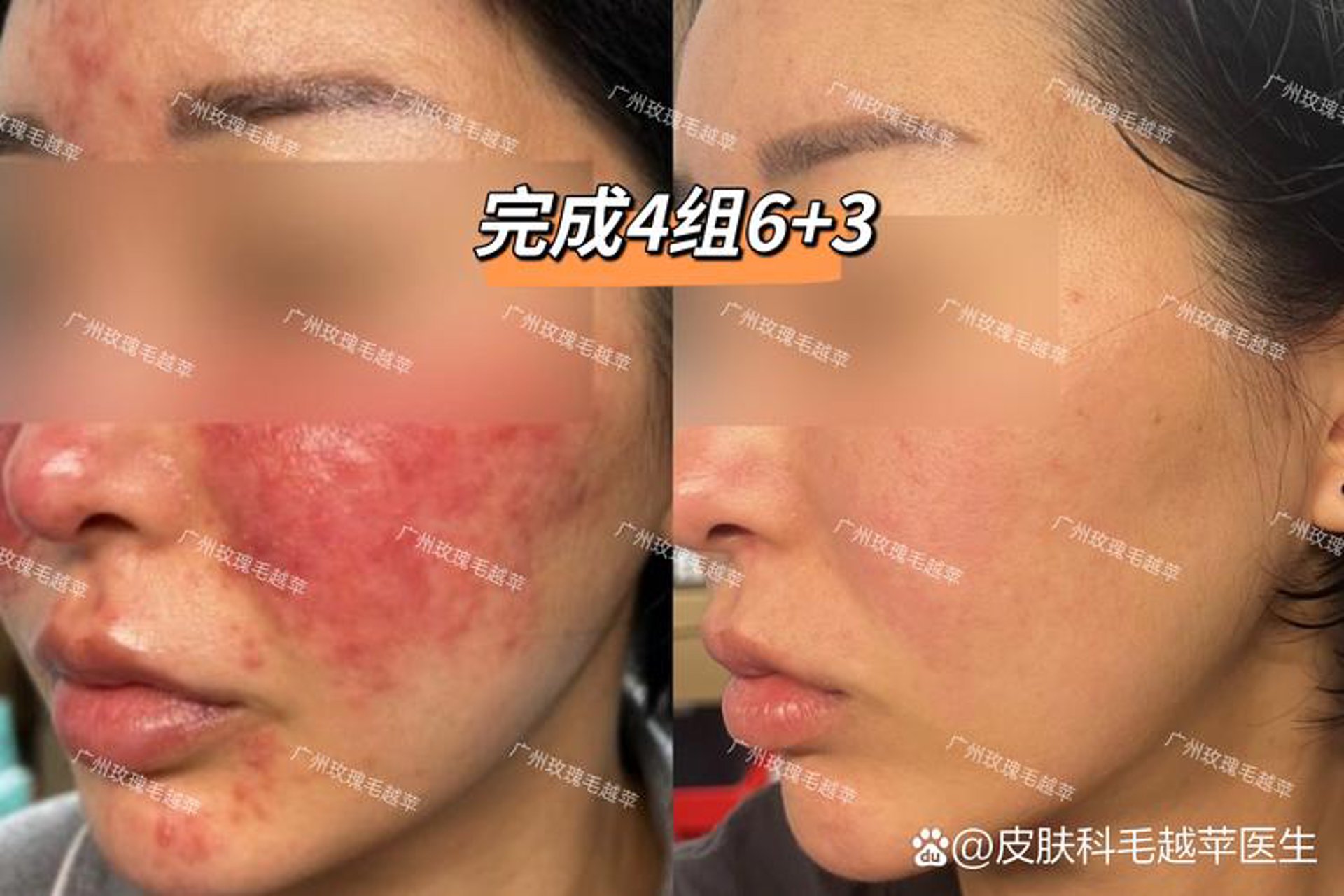 玫瑰红祛痘